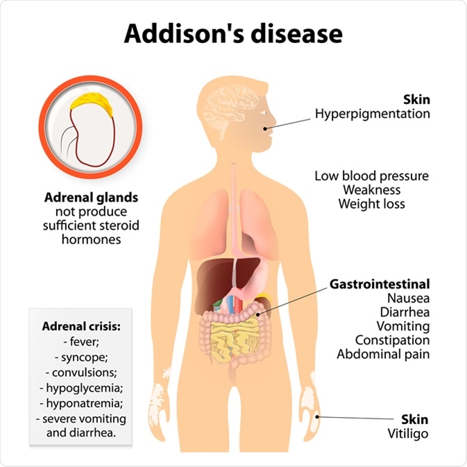 Understanding Addisons Disease Understanding Addisons Disease