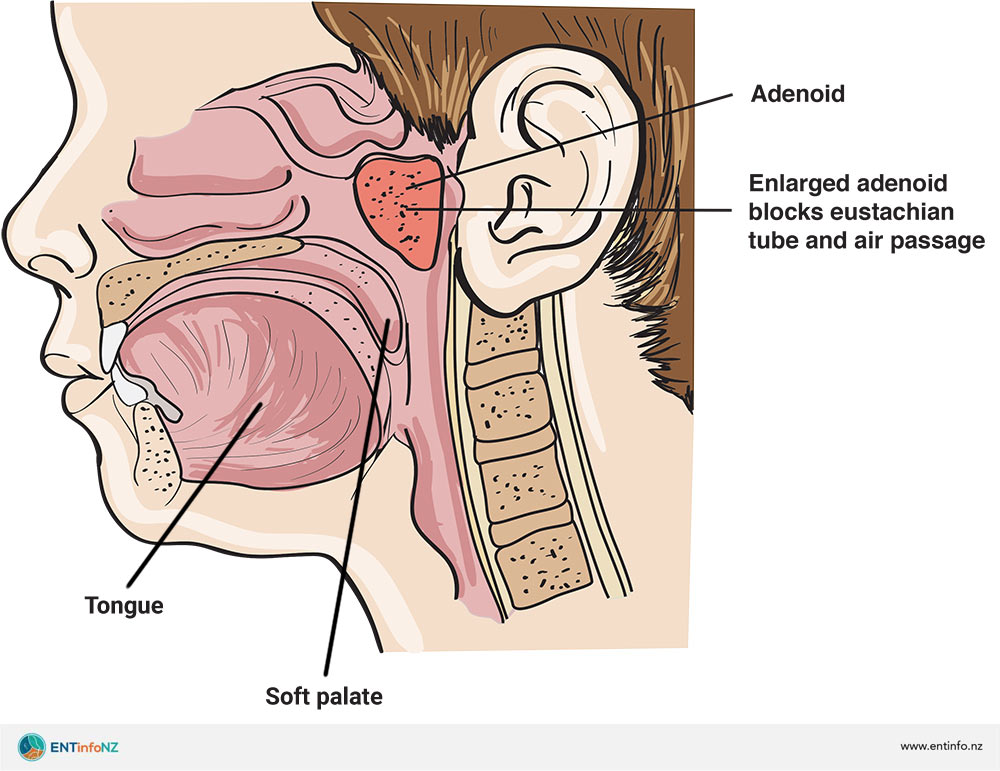 Understanding Adenoiditis Understanding Adenoiditis