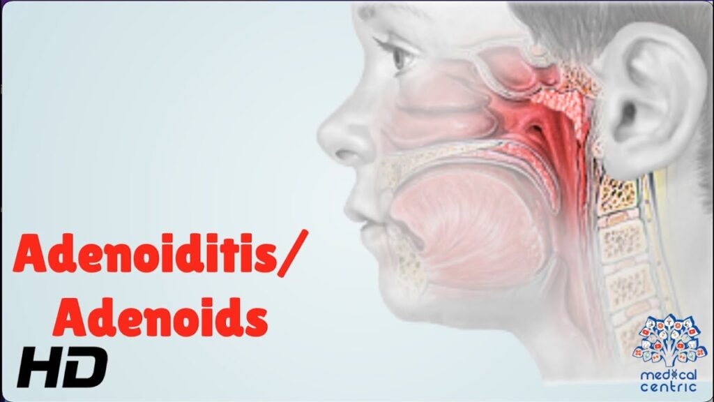 Understanding Adenoiditis Understanding Adenoiditis