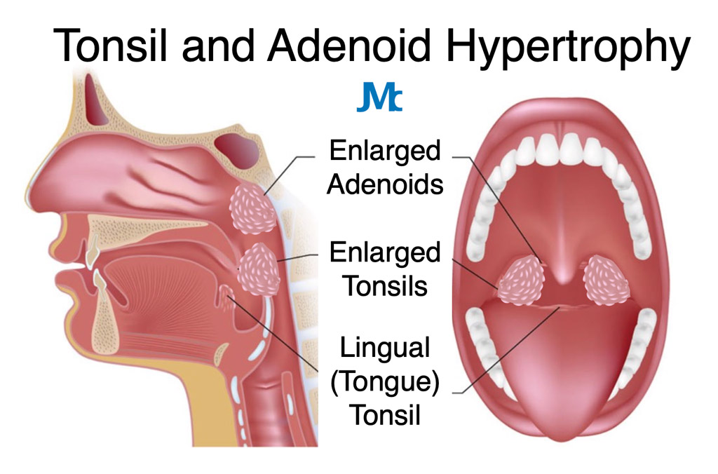 Understanding Adenoiditis Understanding Adenoiditis