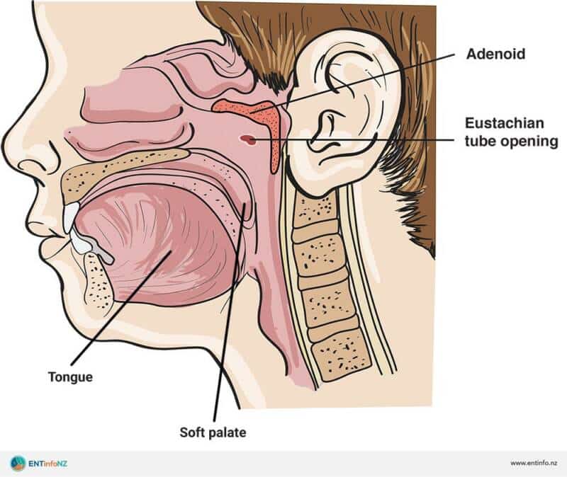 Understanding Adenoiditis Understanding Adenoiditis