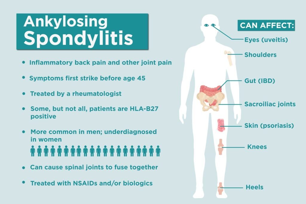 Understanding Ankylosing Spondylitis: Causes, Symptoms, and Treatment