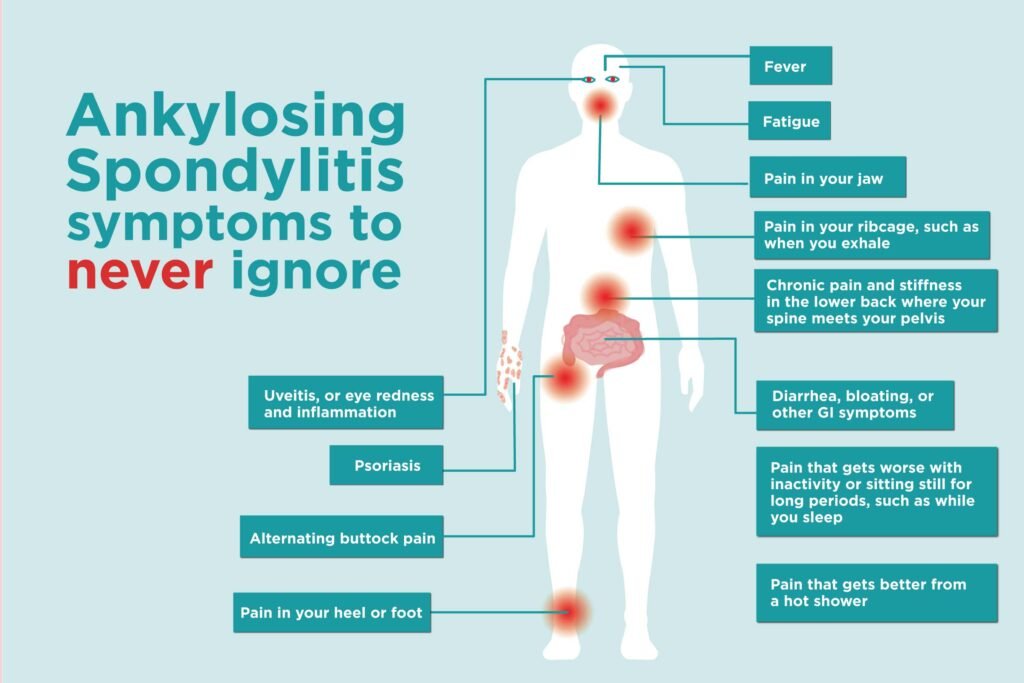 Understanding Ankylosing Spondylitis: Causes, Symptoms, and Treatment