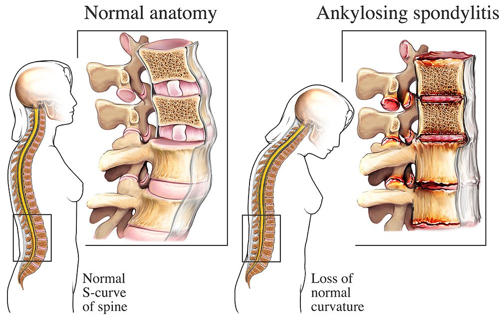 Understanding Ankylosing Spondylitis: Causes, Symptoms, and Treatment