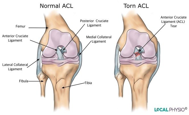 Understanding Anterior Cruciate Ligament (ACL) Injuries