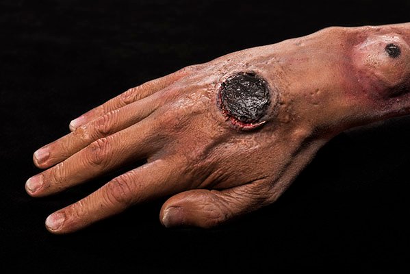 Understanding Anthrax: Symptoms and Treatment