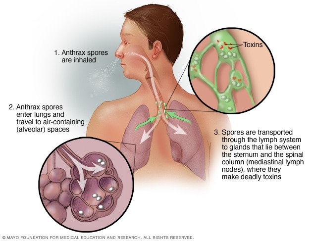 Understanding Anthrax: Symptoms and Treatment