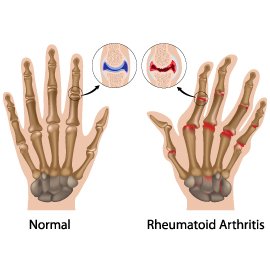 Understanding Arthritis: Causes, Symptoms, and Treatment