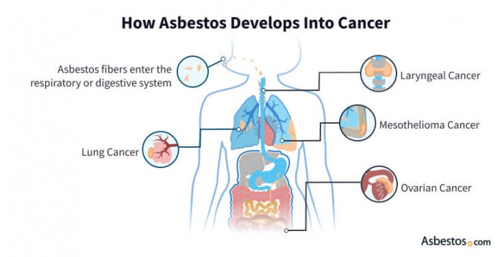 Understanding Asbestos-Related Cancer