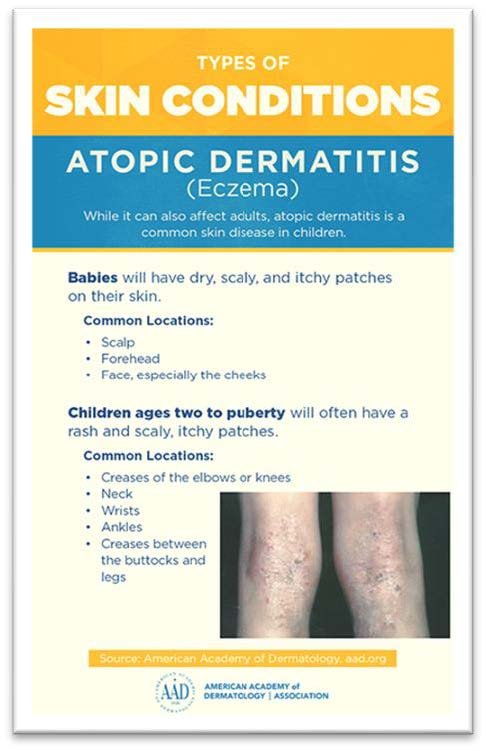 Understanding Atopic Eczema: Causes, Symptoms, And Treatment - Ask The ...