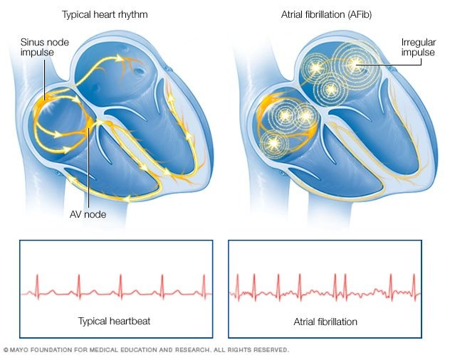 Understanding Atrial Fibrillation