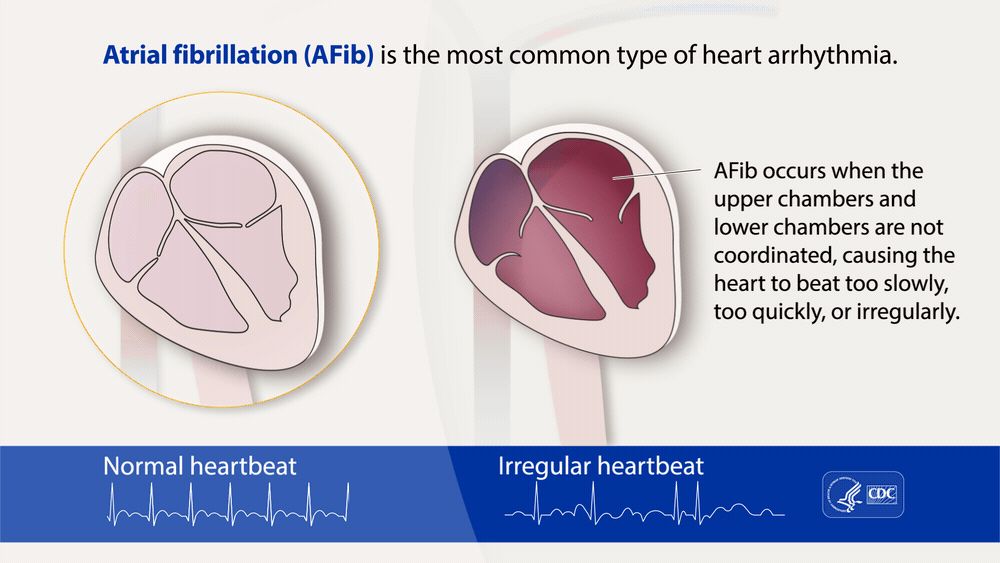 Understanding Atrial Fibrillation