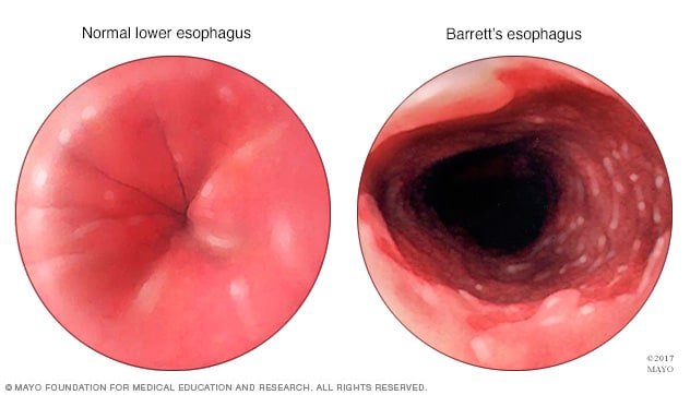 Understanding Barretts Esophagus