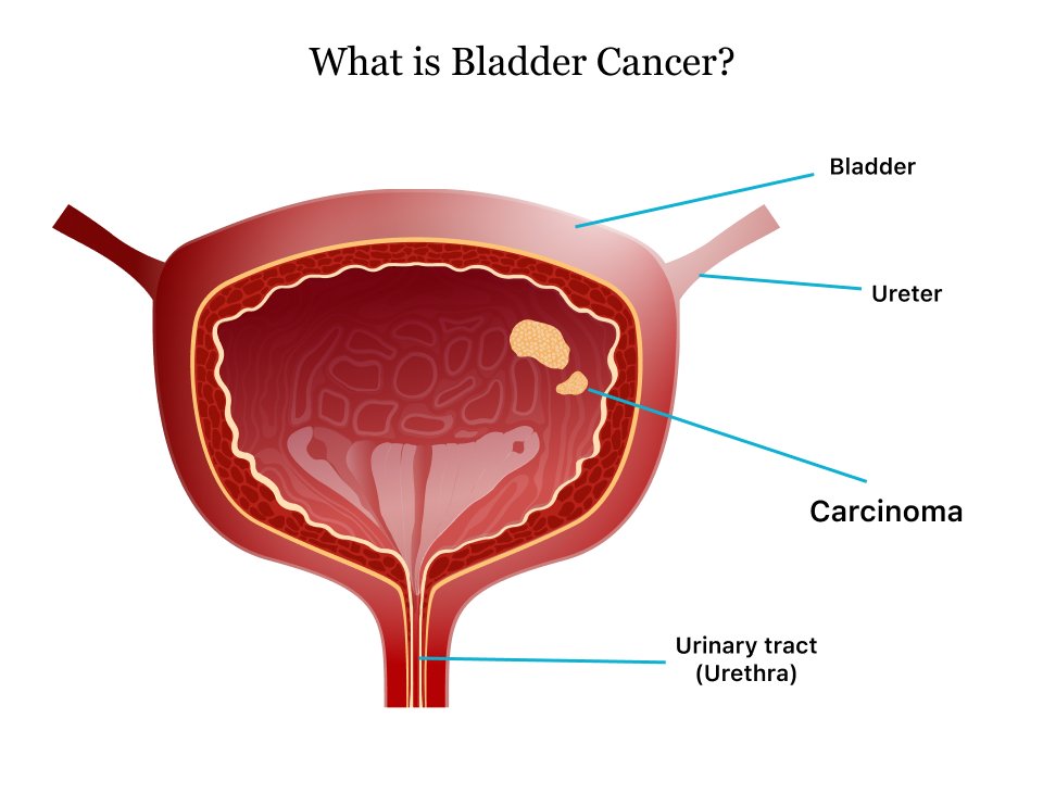 Understanding Bladder Cancer