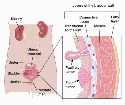 Understanding Bladder Cancer