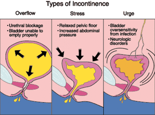 Understanding Bladder Incontinence