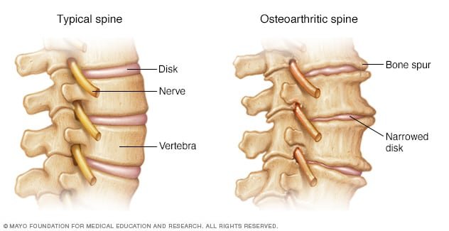 Understanding Bone Spurs: Causes, Symptoms, and Treatment Options