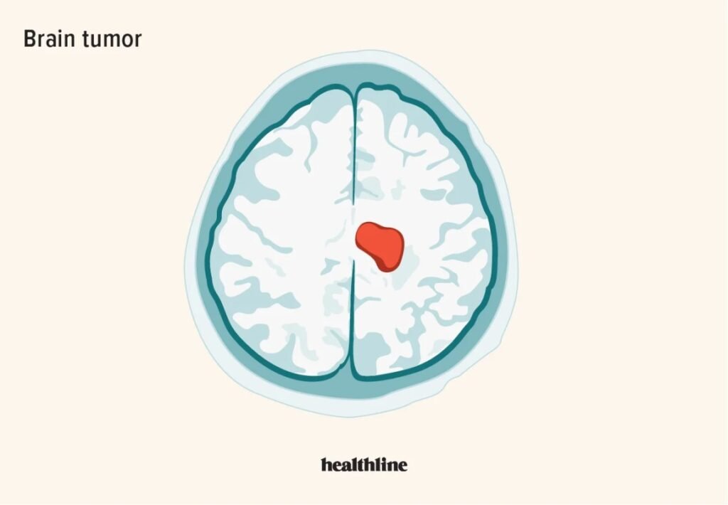Understanding Brain Tumors