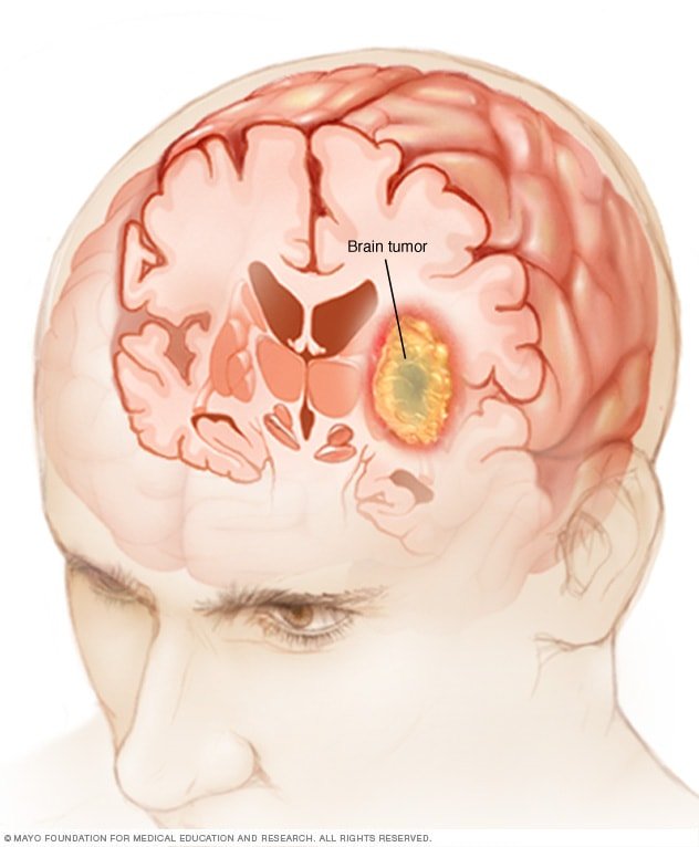 Understanding Brain Tumors