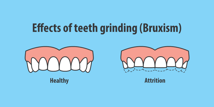 Understanding Bruxism: Causes, Symptoms, and Treatments