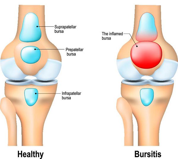 Understanding Bursitis: Causes, Symptoms, and Treatment
