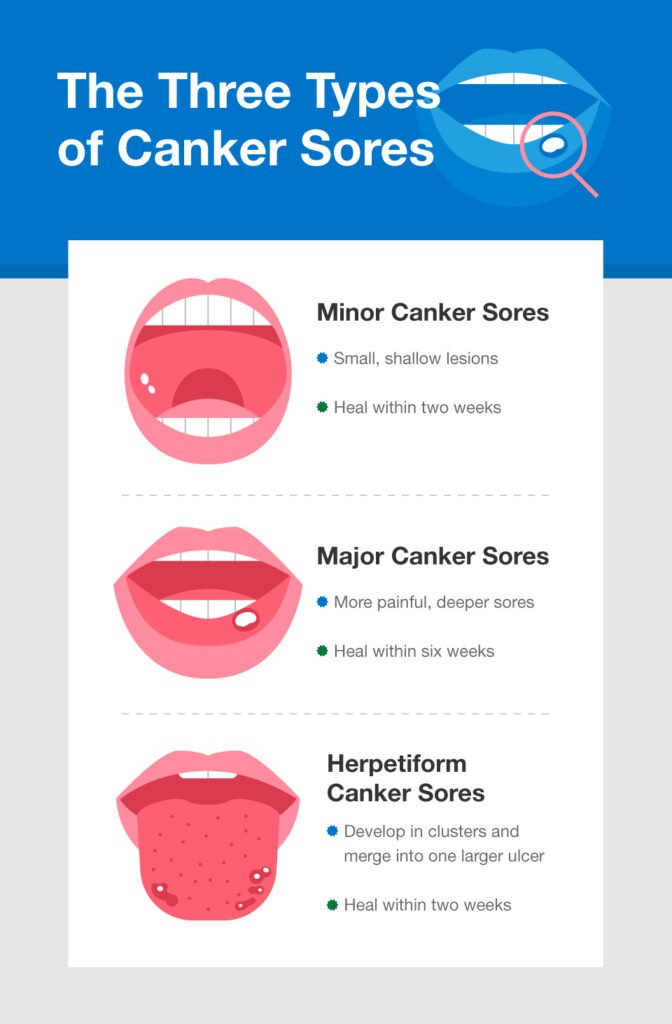 Understanding Canker Sores: Causes and Remedies