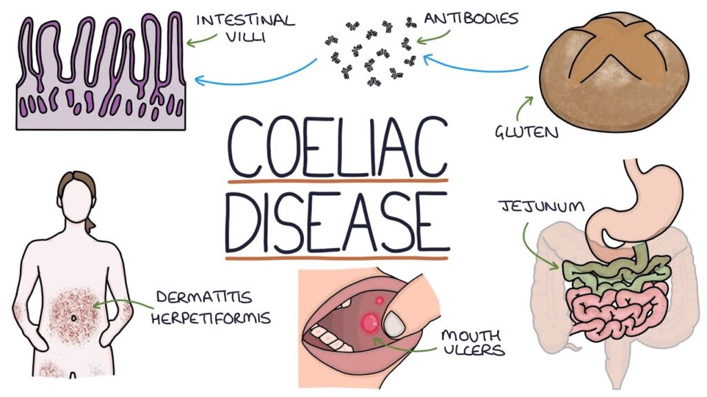 Understanding Celiac Disease Understanding Celiac Disease