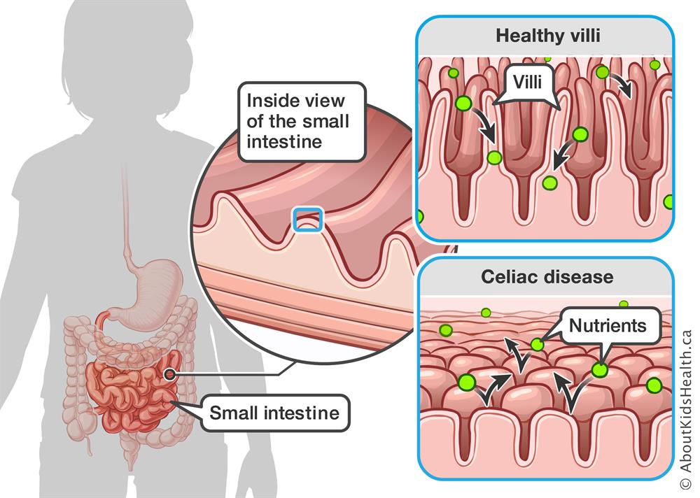 Understanding Celiac Disease Understanding Celiac Disease
