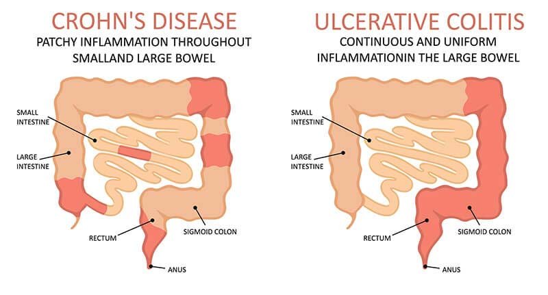 Understanding Crohn’s Disease: Causes, Symptoms, and Treatment