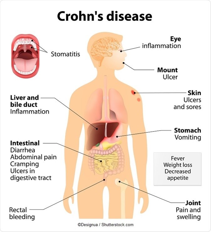 Understanding Crohn’s Disease: Causes, Symptoms, and Treatment