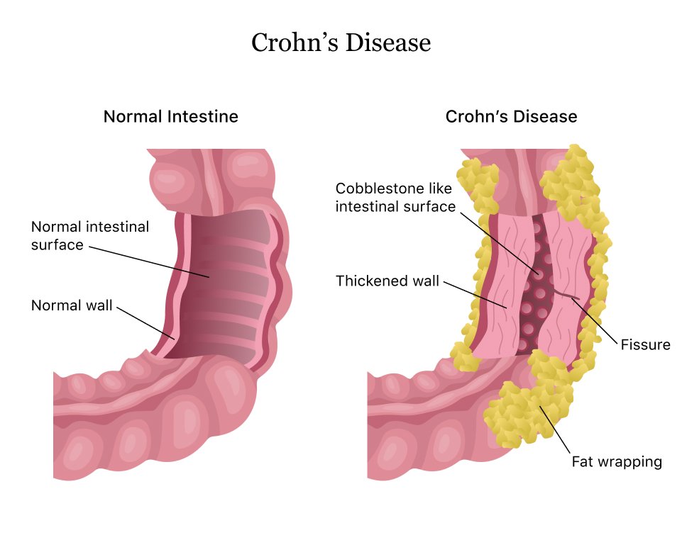 Understanding Crohn’s Disease: Causes, Symptoms, and Treatment