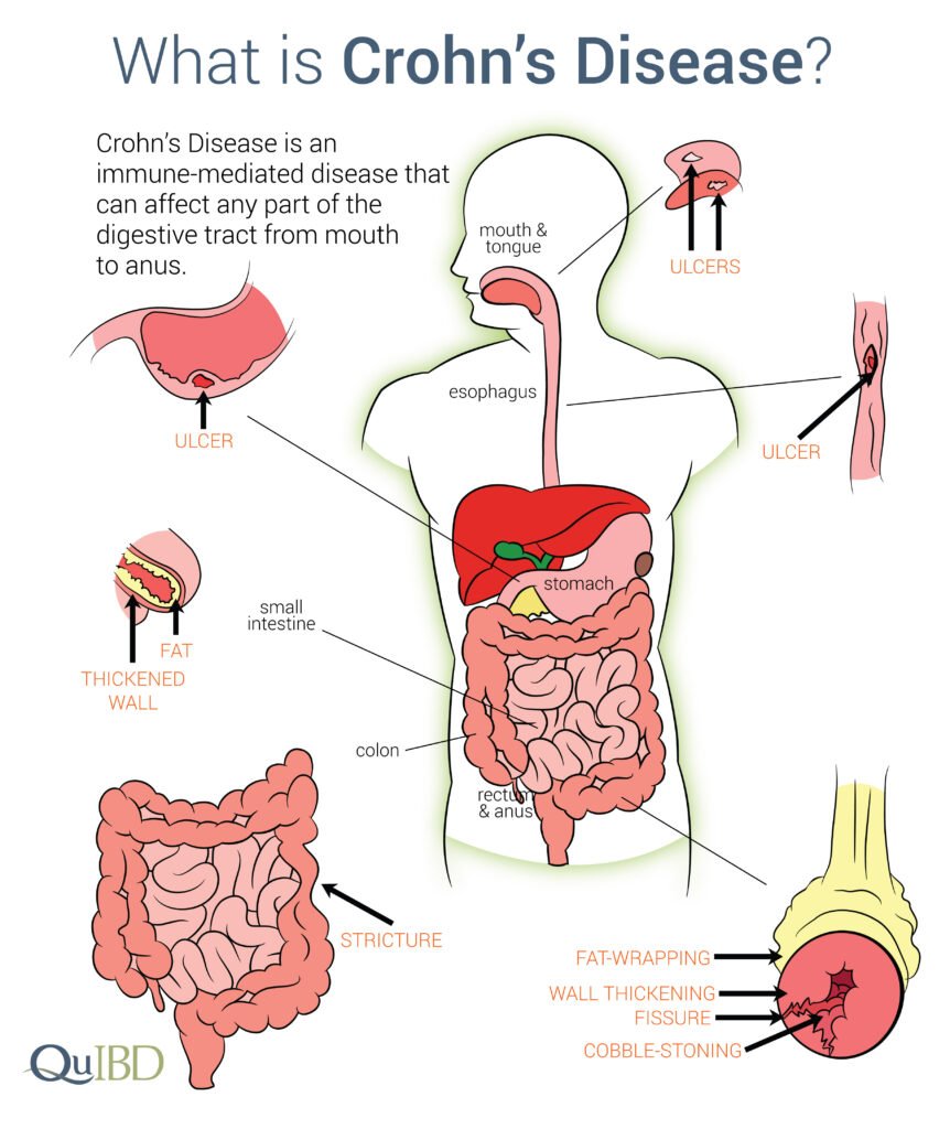Understanding Crohn’s Disease: Causes, Symptoms, and Treatment