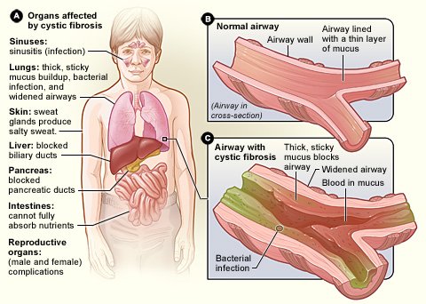 Understanding Cystic Fibrosis: Causes, Symptoms, and Treatment