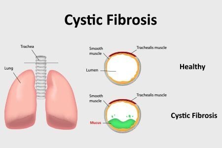 Understanding Cystic Fibrosis: Causes, Symptoms, and Treatment