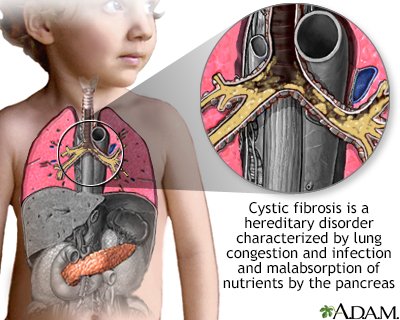 Understanding Cystic Fibrosis: Causes, Symptoms, and Treatment