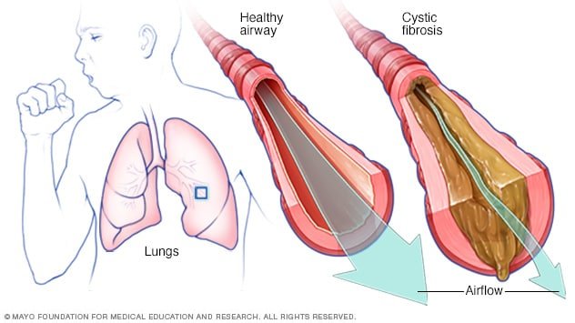 Understanding Cystic Fibrosis: Causes, Symptoms, and Treatment
