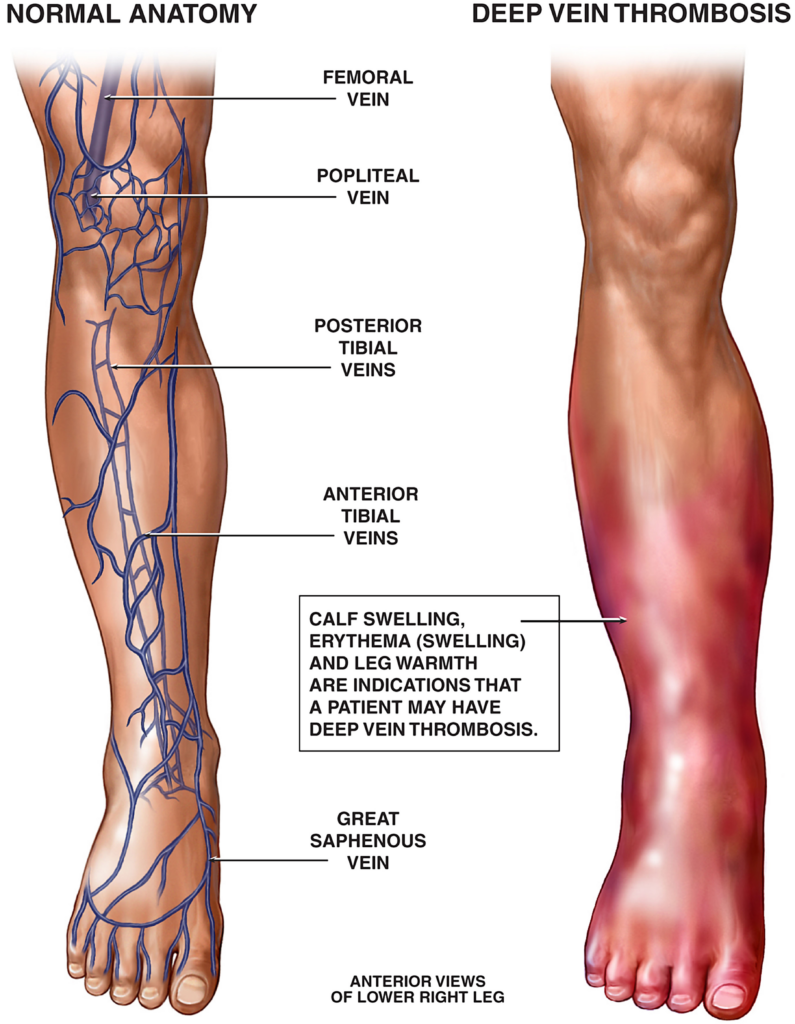 Understanding Deep Vein Thrombosis Understanding Deep Vein Thrombosis