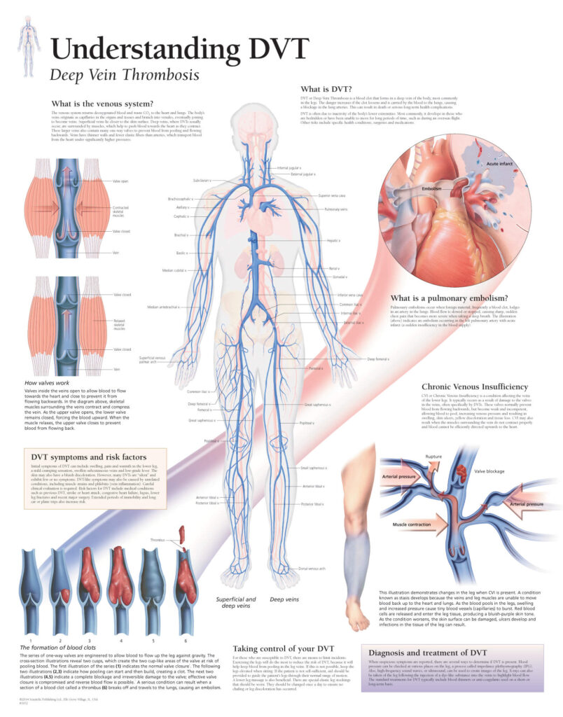Understanding Deep Vein Thrombosis Understanding Deep Vein Thrombosis