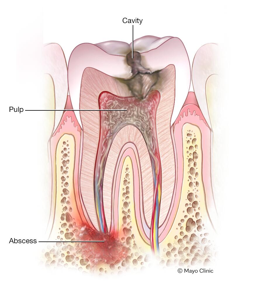Understanding Dental Abscesses Understanding Dental Abscesses