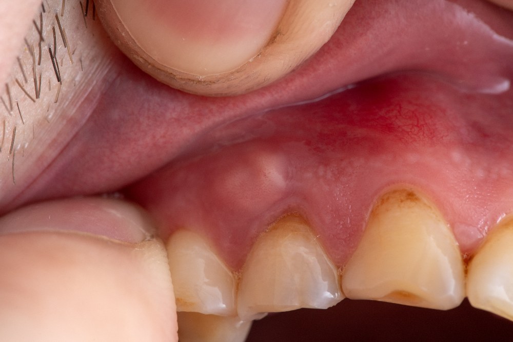 Understanding Dental Abscesses Understanding Dental Abscesses