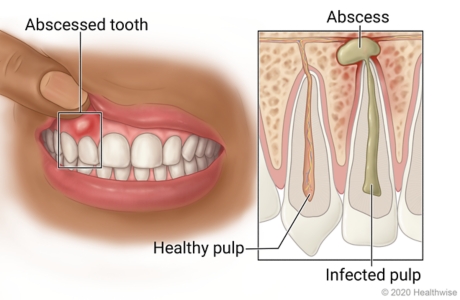 Understanding Dental Abscesses Understanding Dental Abscesses