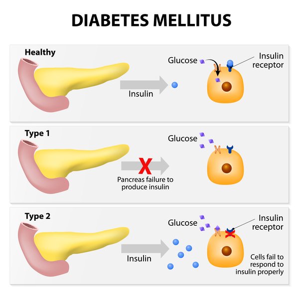 Understanding Diabetes Mellitus