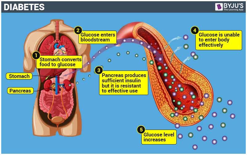 Understanding Diabetes Mellitus