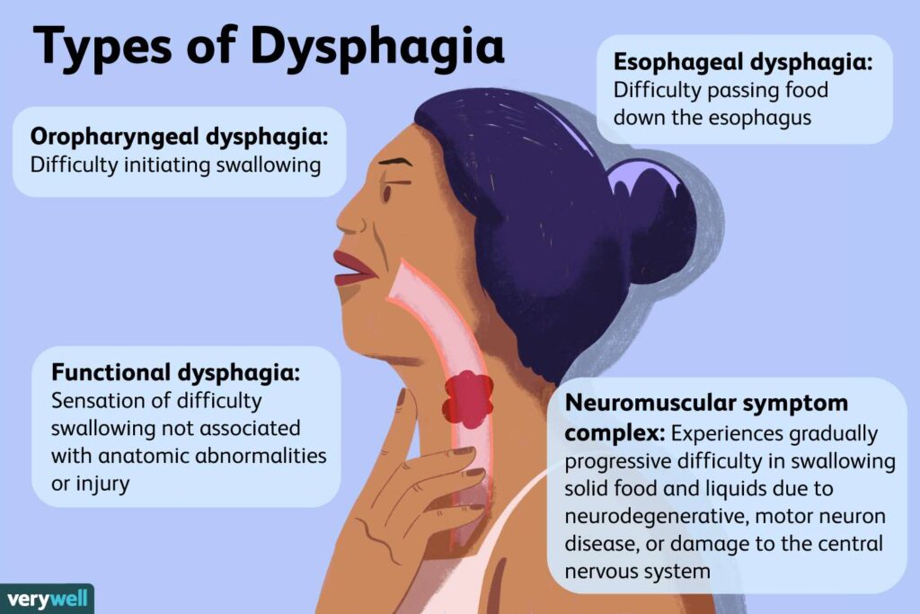 Understanding Dysphagia: Causes, Symptoms, and Treatment