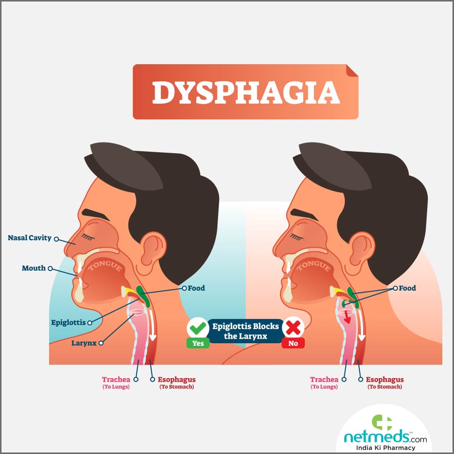 Understanding Dysphagia: Causes, Symptoms, and Treatment