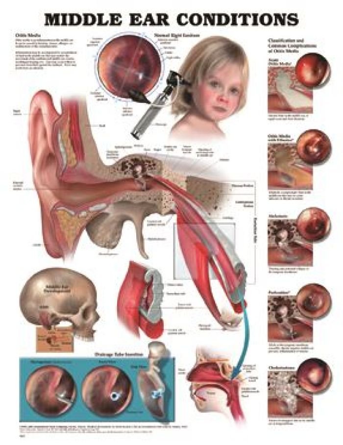 Understanding Ear Infections