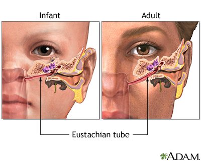Understanding Ear Infections