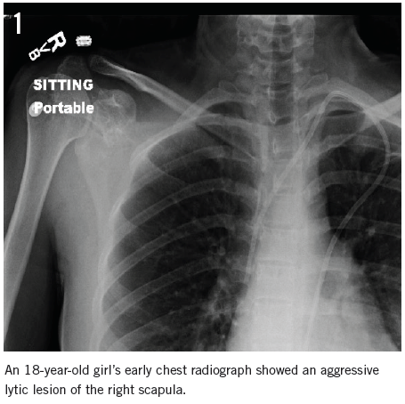Understanding Ewing Sarcoma