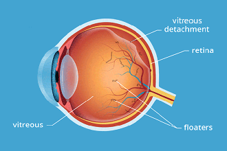 Understanding Eye Floaters: Causes and Treatment Options