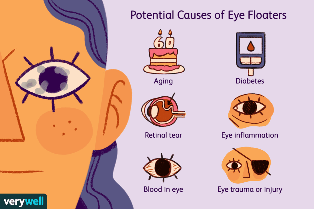 Understanding Eye Floaters Causes And Treatment Options